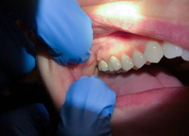 Best Emergency Root Canal Treatment in Payson, IL