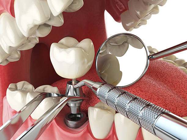 Best Emergency Dentist for Lost Fillings or Crowns in Payson, IL